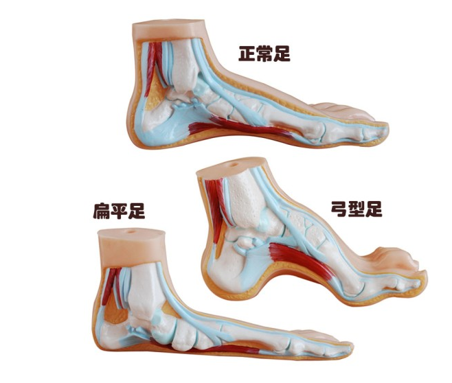 正常足(扁平足、弓型足)模型